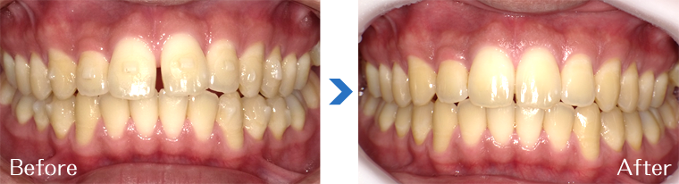 インビザライン症例