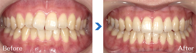 インビザライン症例