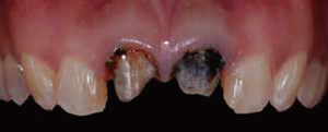 審美歯科症例1-2