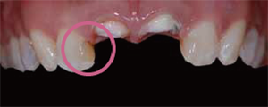 審美歯科症例1-5