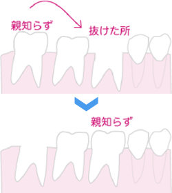 自家歯牙移植