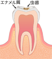Ｃ１：歯の表層（エナメル質）の虫歯