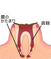 Ｃ４：歯の根まで達した虫歯