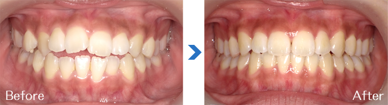 インビザライン症例