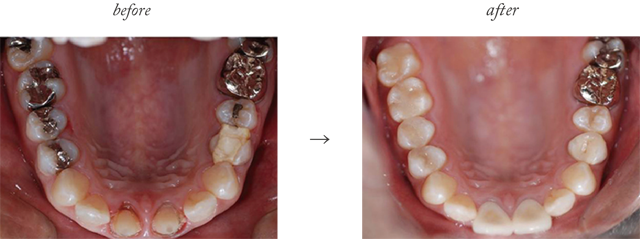 審美歯科症例5