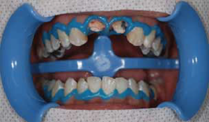 審美歯科症例1-3