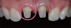 審美歯科症例1-6
