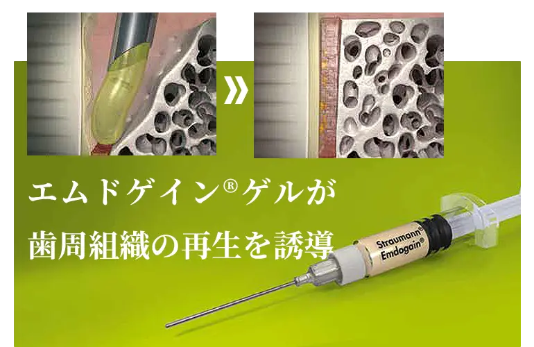 歯周再生療法