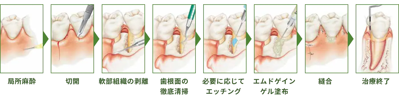 歯周再生療法