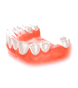 歯を1本失った場合