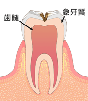 C2:歯の中(象牙質)の虫歯