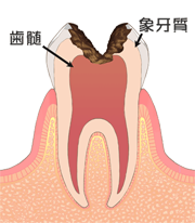 C3:神経まで達した虫歯